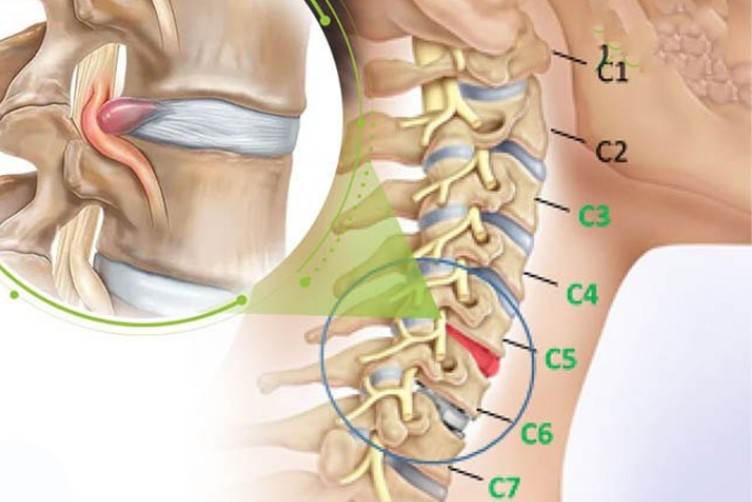 Thoát vị đĩa đệm cổ: Dấu hiệu nhận biết, chẩn đoán và điều trị