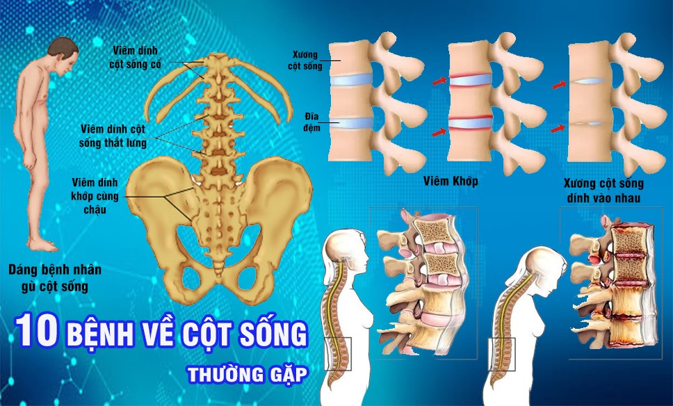 10 bệnh cột sống thường gặp: Nguyên nhân, chẩn đoán và phòng ngừa