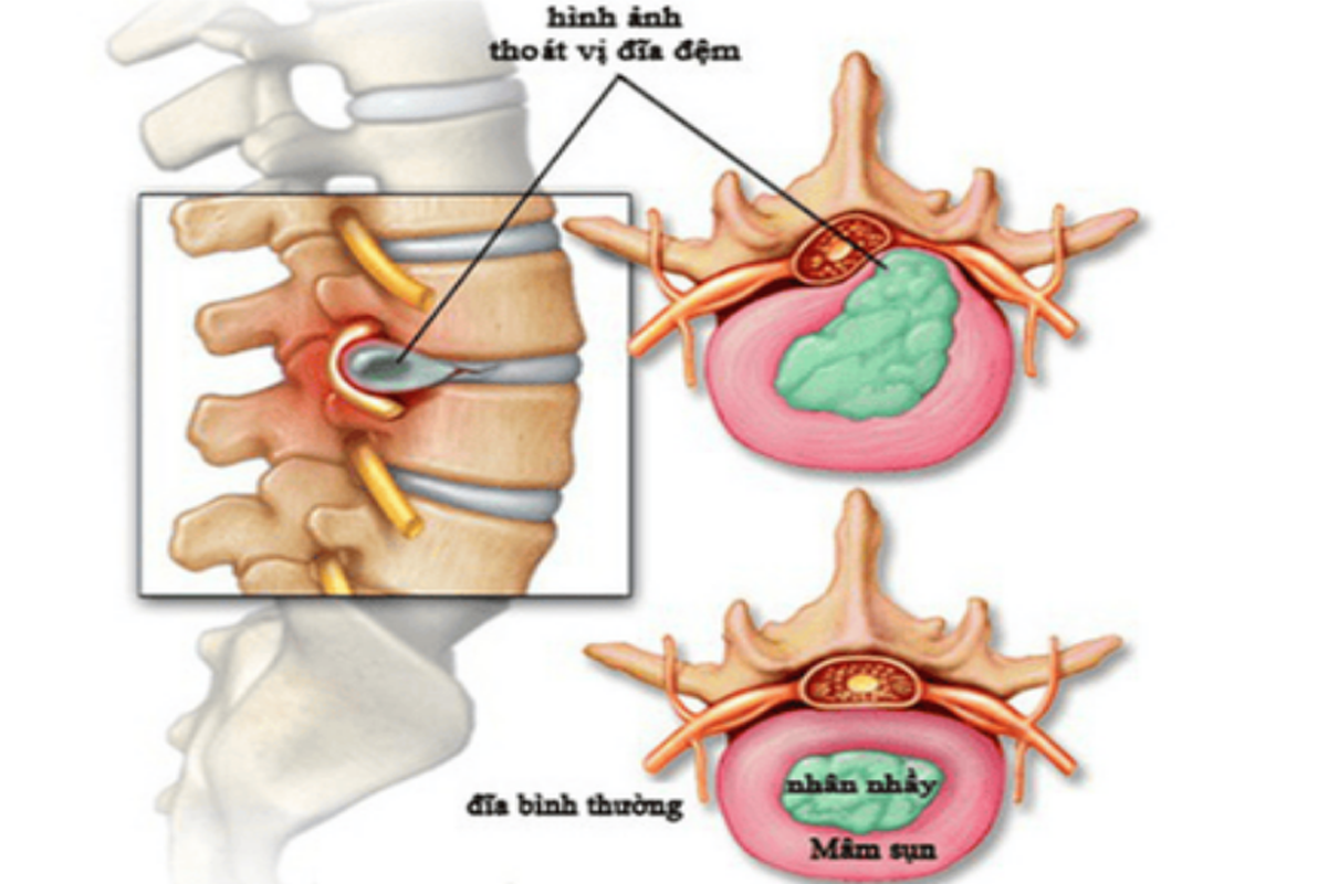 Thoát vị đĩa đệm: Nguyên nhân, triệu chứng, chẩn đoán và điều trị