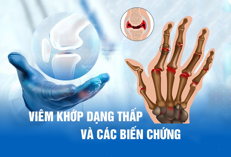 Viêm khớp dạng thấp và các biến chứng nguy hiểm