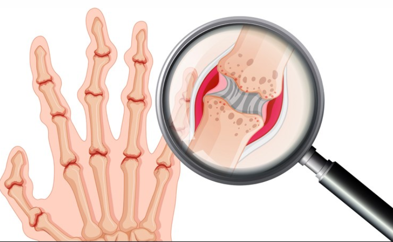 Viêm khớp dạng thấp: Nguyên nhân, triệu chứng, chẩn đoán và điều trị