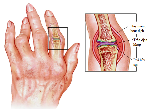 Dấu hiệu cảnh báo viêm khớp dạng thấp