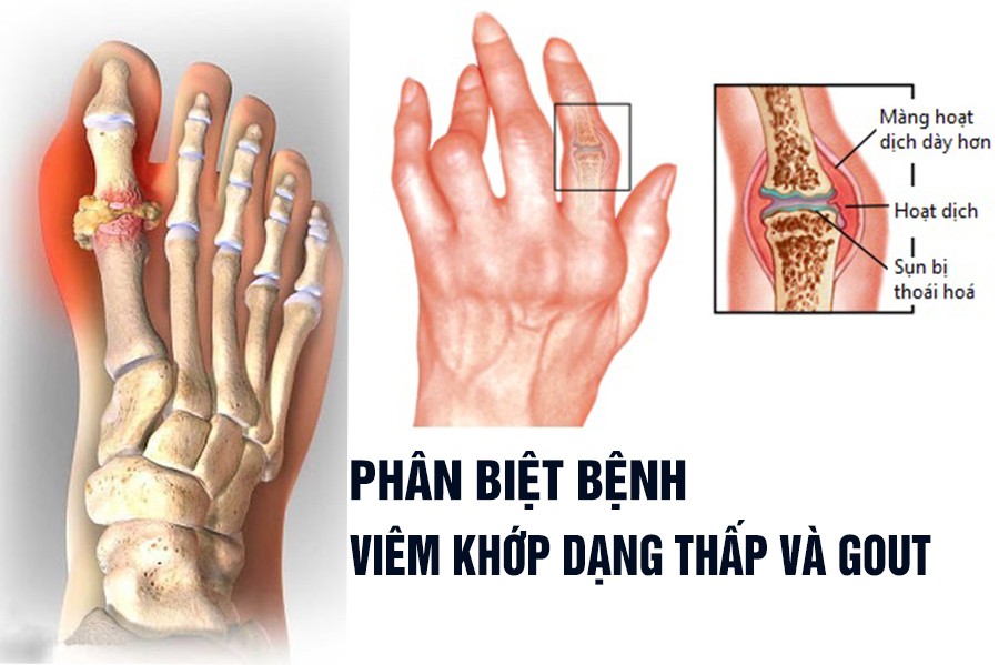 Phân biệt bệnh Viêm khớp dạng thấp và Gout