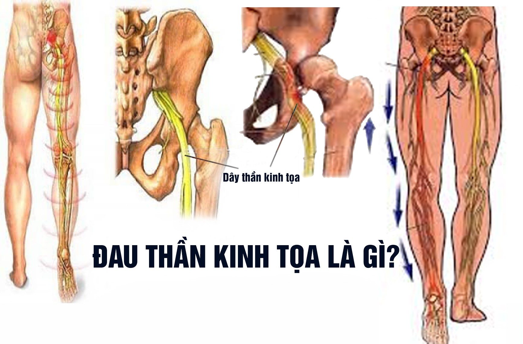 Đau thần kinh tọa: Nguyên nhân, triệu chứng, điều trị và cách phòng ngừa