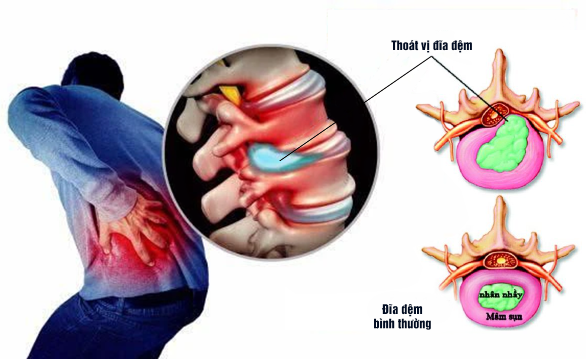 Nguyên nhân gây thoát vị đĩa đệm và các biến chứng nguy hiểm